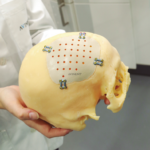 Craneoplástias personalizadas Avinent